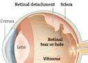 Detached retina can lead to blindness