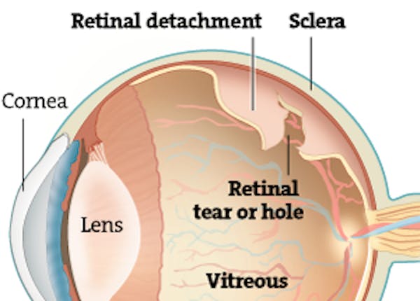 Detached retina can lead to blindness