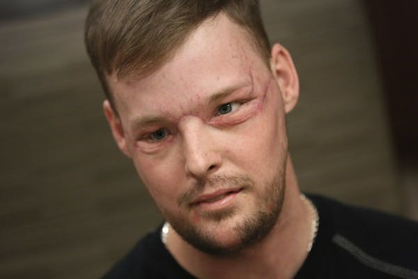 In this Jan. 24, 2017, photo, face transplant recipient Andy Sandness attends a speech therapy appointment at Mayo Clinic in Rochester, Minn. He wasn'