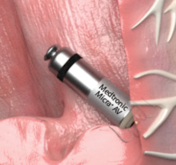 The Micra pacemaker is delivered through blood vessels and attached without lead wires.