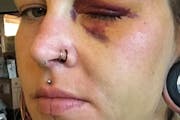 Police shot Samantha Wright in the face with a less-lethal projectile on May 30, 2020, leaving her with permanent eye damage.