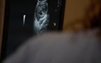 An ultrasound of a fetus. 