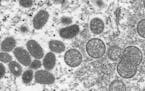 Mature, oval-shaped monkeypox virions, left, and spherical immature virions, right, are shown in a 2003 electron microscope image made available by th