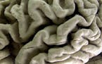 This Oct. 7, 2003 file photo shows a closeup of a human brain affected by Alzheimer’s disease, on display at the Museum of Neuroanatomy at the Unive