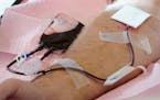 FILE - Tubes direct blood from a donor into a bag in Davenport, Iowa, on Friday, Nov. 11, 2022. The U.S. is moving to ease restrictions on blood donat