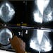 A radiologist used a magnifying glass to check mammograms for breast cancer in Los Angeles, May 6, 2010. 